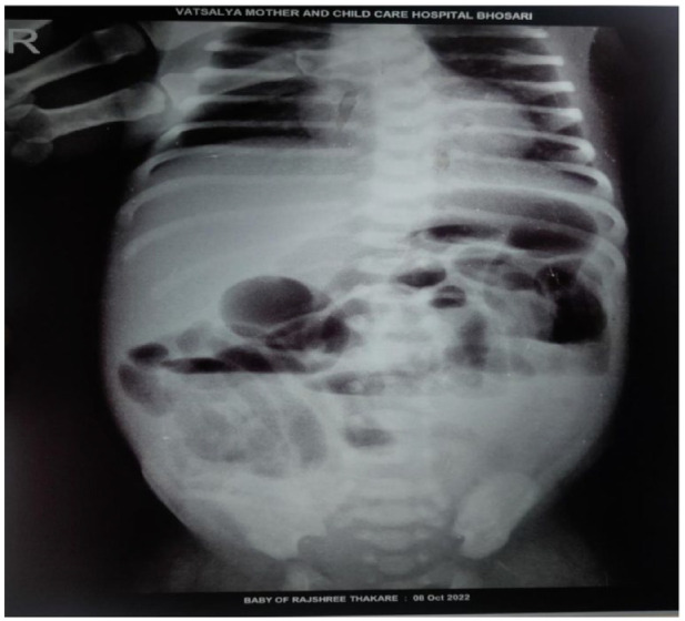 Early Detection and Intervention for Hirschsprung's Disease: A Key to Successful Outcomes.