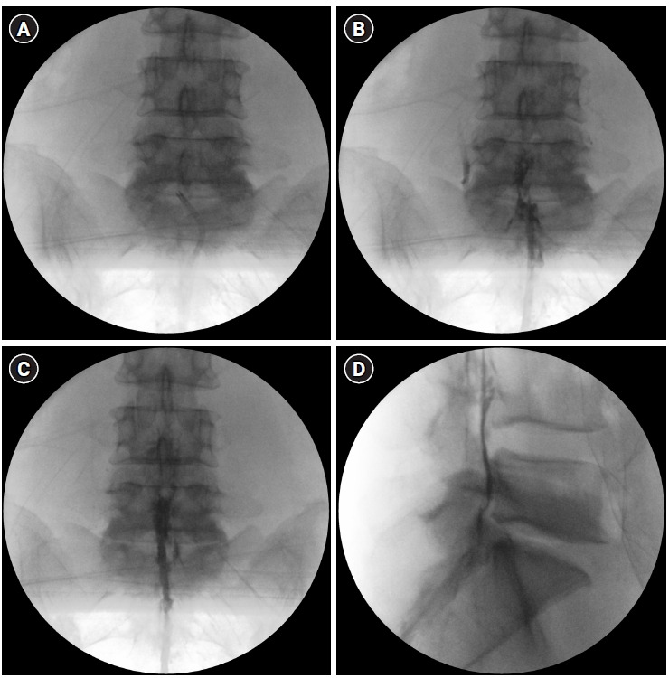 Multimodal management strategies for chronic pain after spinal surgery: a comprehensive review.