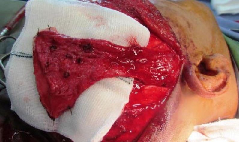 Temporoparietal Flap for Facial Reconstruction: Donor Site Morbidity.