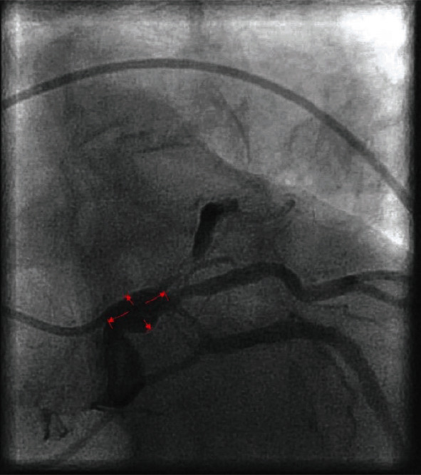 Rare Manifestation of COVID-19 Resulting in Coronary Artery Vasculitis.