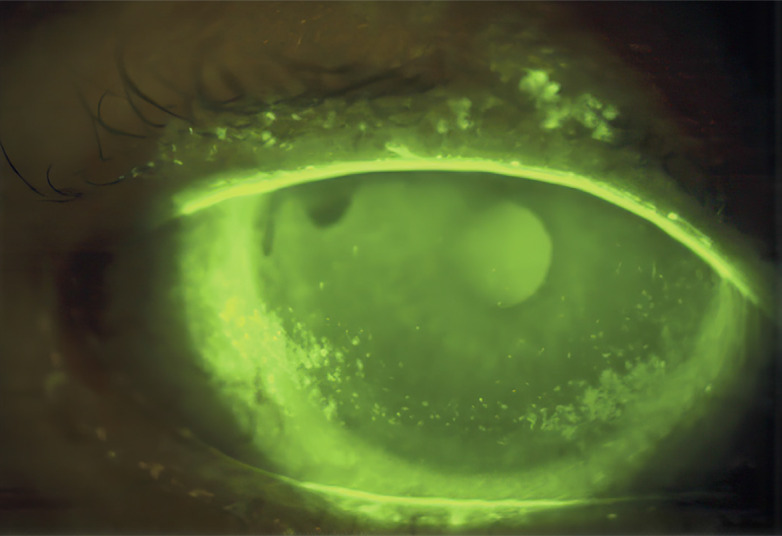 Managing dry eye disease.