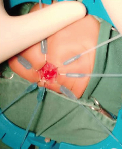 Our Experience of the De la Torre-Mondragon Technique in the Surgical Management of Hirschsprung's Disease: A Report on 52 Cases.