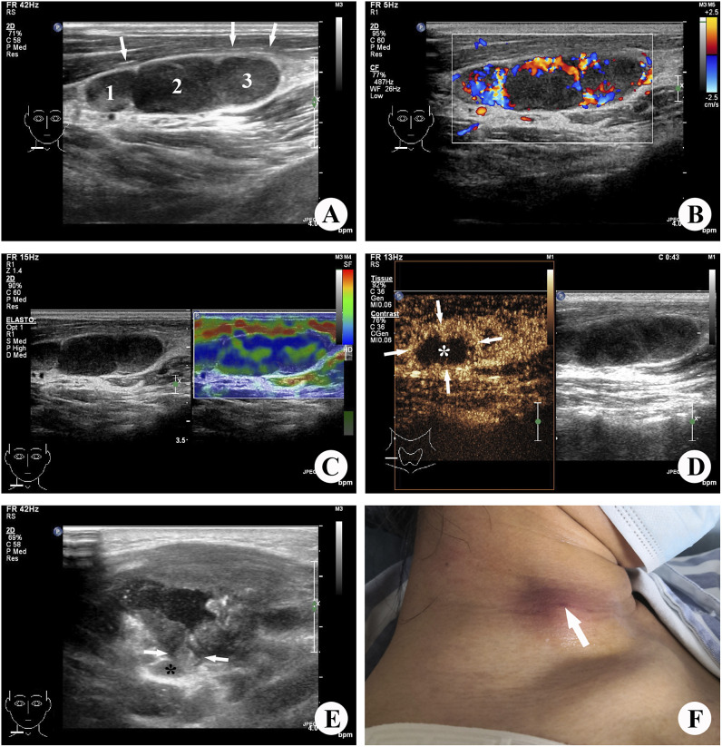 Application of ultrasound multimodal imaging in the prediction of cervical tuberculous lymphadenitis rupture.