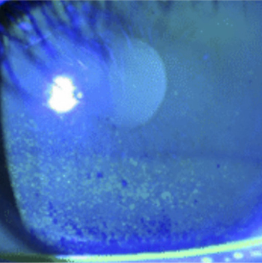 Dry eye disease: an introduction.