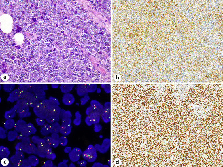 Molecular Characterization and Genetic Subclassification Comparison of Diffuse Large B-Cell Lymphoma: Real-Life Experience with 74 Cases.