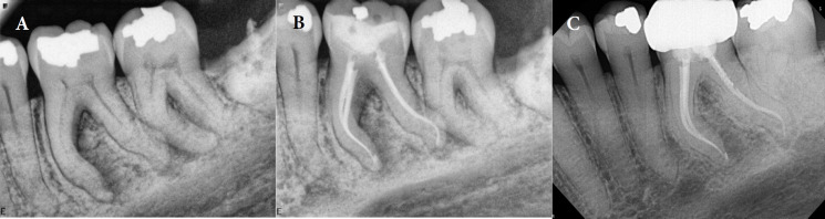 Enhancing Coronal Adaptation of Root Canal Fillings with a Modified Single-Cone Obturation Technique: Two Case Reports.