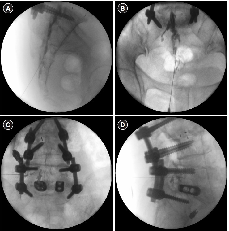 Multimodal management strategies for chronic pain after spinal surgery: a comprehensive review.