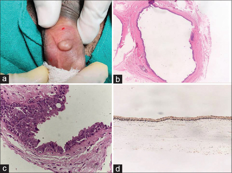 Apocrine Hidrocystoma: A Rare Benign Cystic Skin Tumor at Uncommon Site.