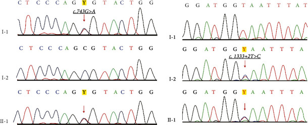 Delayed Diagnosis of Perrault Syndrome: A Rare Genetic Disorder.