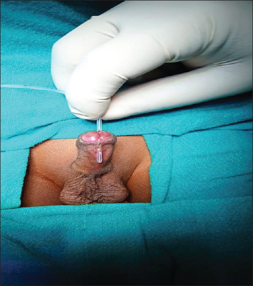 Congenital Urethrocutaneous Fistula.