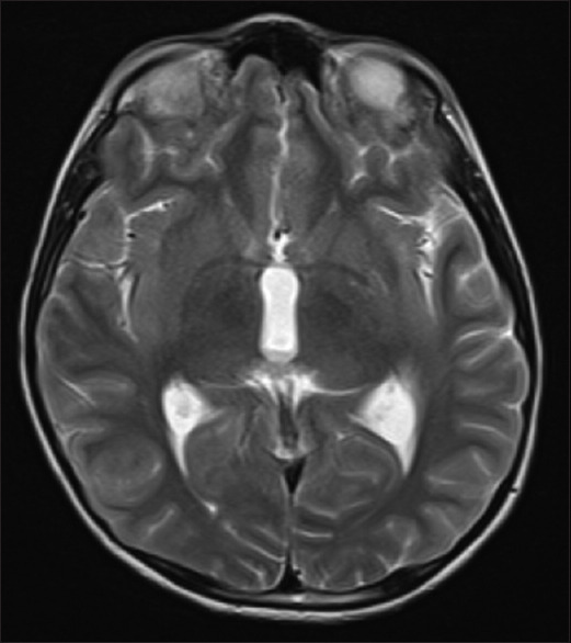 Primary diffuse leptomeningeal primitive neuroectodermal tumor presenting as chronic meningitis.