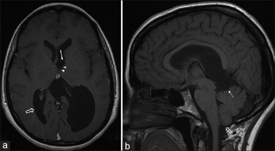 Intraventricular membrane with ventricular diverticulum.