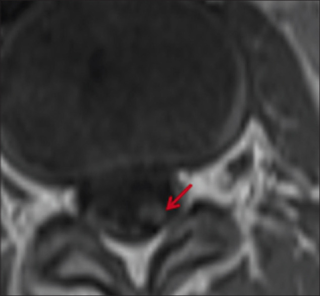 Primary diffuse leptomeningeal primitive neuroectodermal tumor presenting as chronic meningitis.