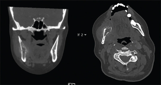 Impact of Early Diagnosis of Maxillofacial Metastases on Treatment and Patient Outcomes - A Retrospective Study.