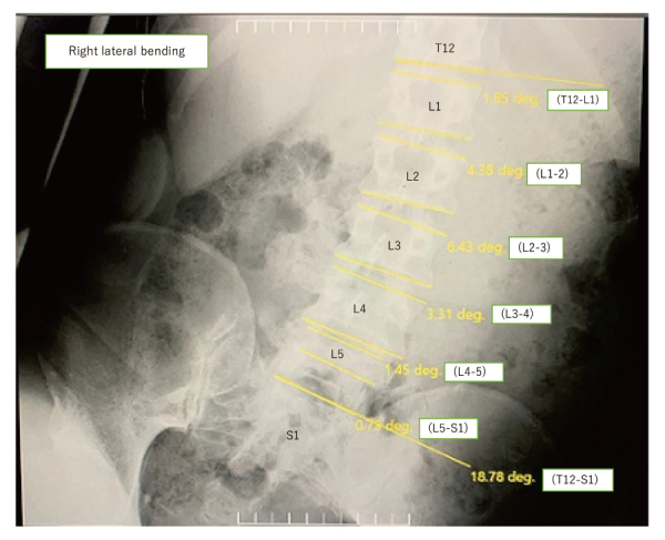 Reference values of lumbar spine range of motion by sex and age based on the assessment of supine trunk lateral bending-A preliminary study.