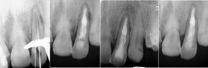Photodynamic Therapy in a Lateral Maxillary Incisor with Dens in Dente Type Ⅱ and Primary Endodontic Lesion: Case Report.