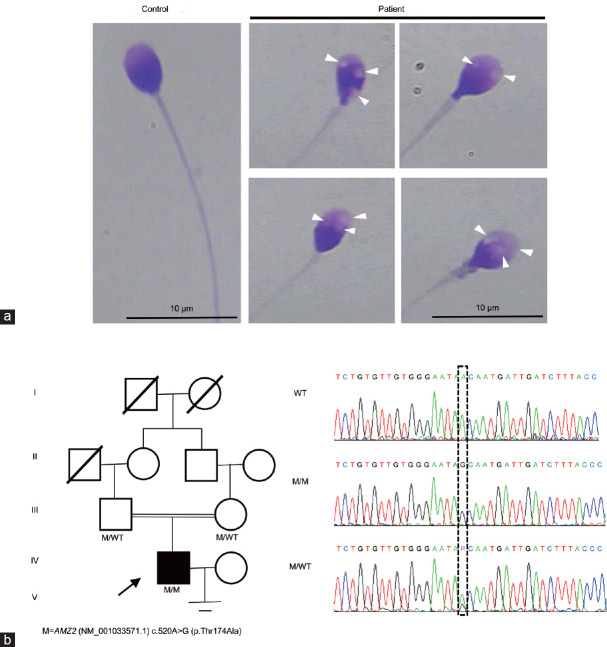The identification of AMZ2 as a candidate causative gene in a severe teratozoospermia patient characterized by vacuolated spermatozoa.