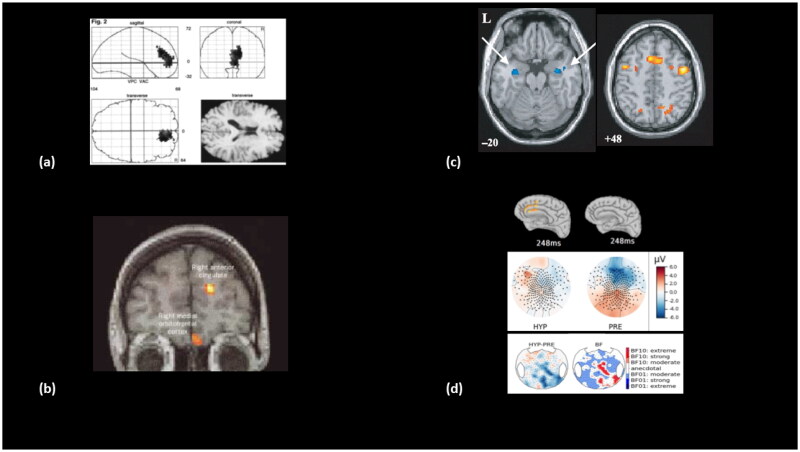 A global neuronal workspace model of functional neurological disorders.