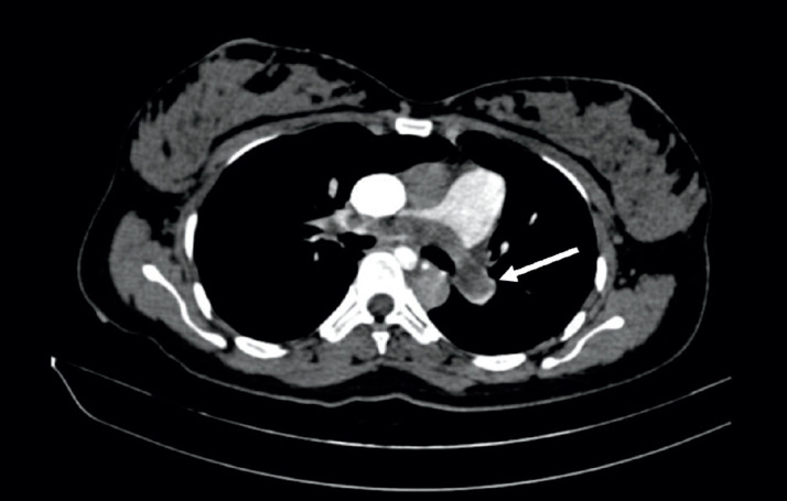 Cardiac Arrest Caused by Amniotic Fluid Embolism: a Report of Two Clinical Cases.