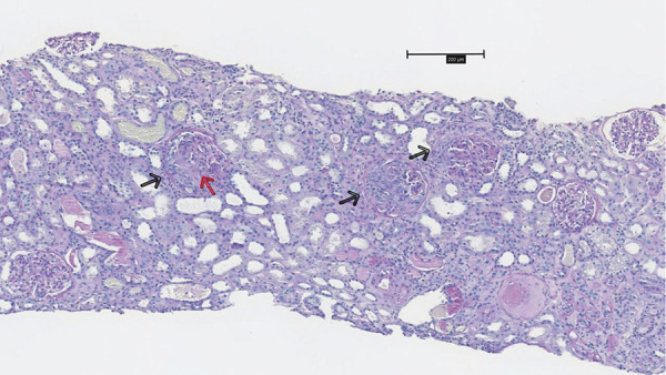 A case report of atypical anti-glomerular basement membrane nephritis associated with Mycobacterium Avium.
