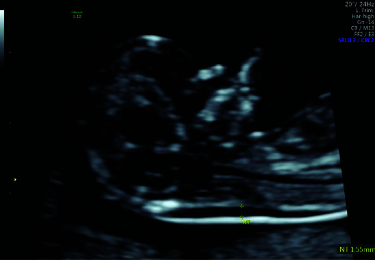 Nuchal Translucency and Congenital Heart Defects.