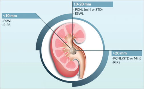 The Saudi urological association guidelines on urolithiasis.