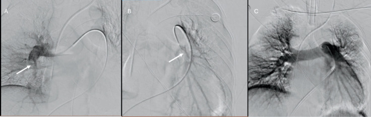Cardiac Arrest Caused by Amniotic Fluid Embolism: a Report of Two Clinical Cases.