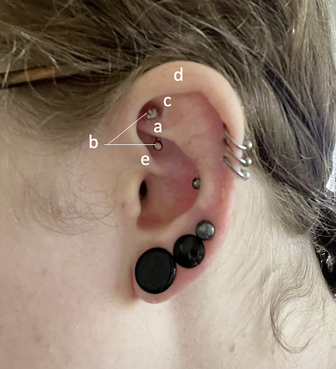 Migraine Symptoms Induced by an Auricular Piercing in a 27-Year-Old Female: A Case Report.
