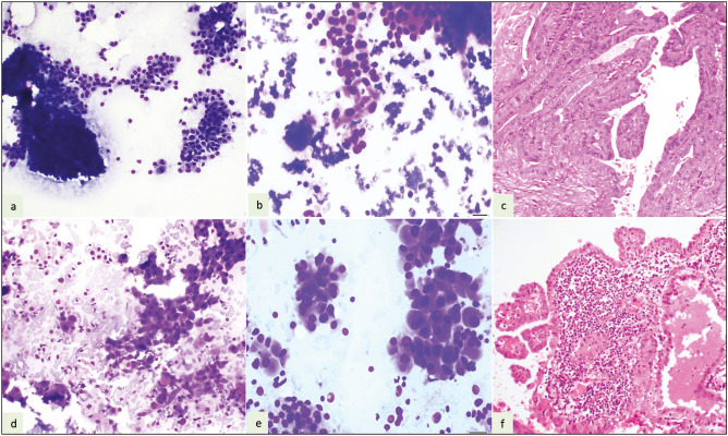 An Algorithmic Approach to Defining Variants of Papillary Thyroid Carcinoma: Accuracy of Fine Needle Aspiration Cytology.