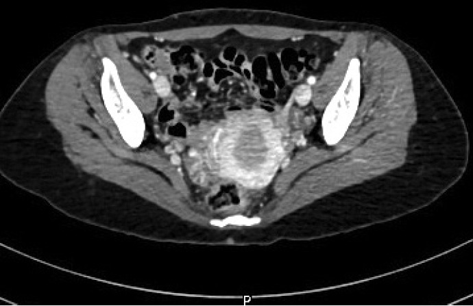 Primary leiomyosarcoma of the bone: a case report.