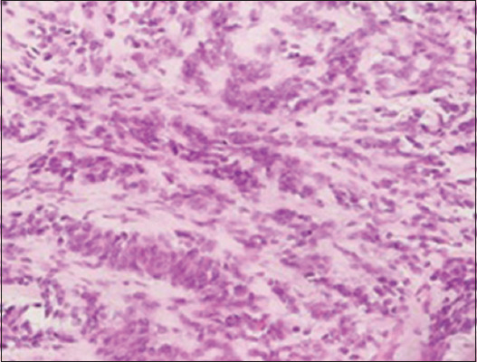 Pediatric Ewing Sarcoma of Kidney: A Case Series and Review of Literature.