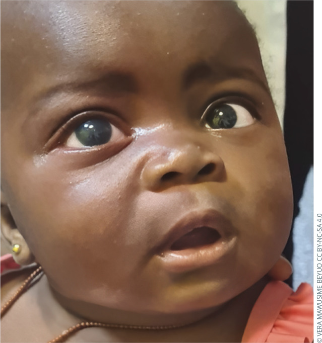Congenital glaucoma: the 'not-so-silent' thief of sight in children.