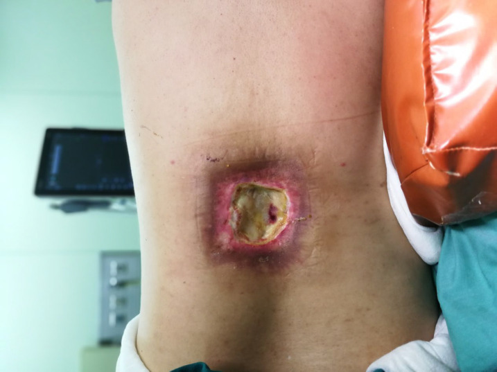 Reverse Turnover Pedicled Latissimus Dorsi Muscle Flap for the Repair of Radiation Ulcer in the Back: A Case Report.