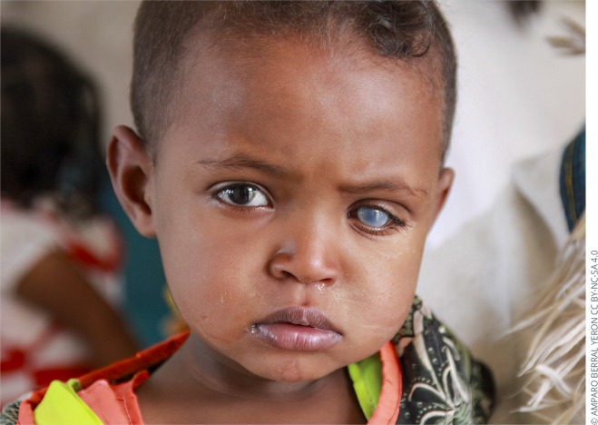 Congenital glaucoma: the 'not-so-silent' thief of sight in children.