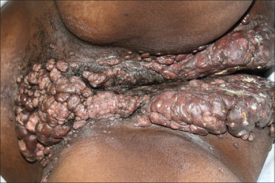 Atypical presentation of molluscum contagiosum infection in a human immunodeficiency virus-positive patient.