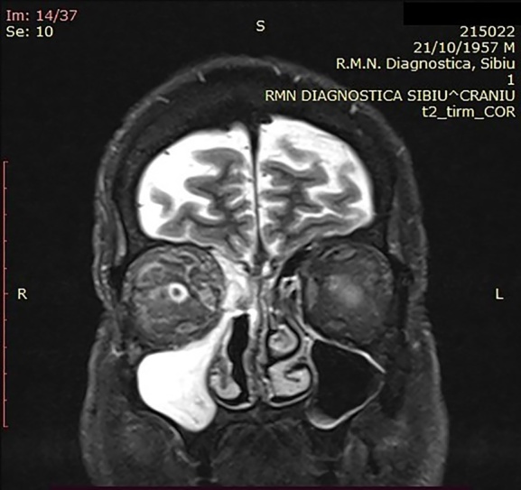 Magnetic Resonance Imaging in COVID-19 Associated Rhino-Sinusal Mucormycosis.