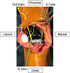 High-concentration continuous local antibacterial perfusion therapy: safety and potential efficacy for acute and chronic periprosthetic knee joint infection.