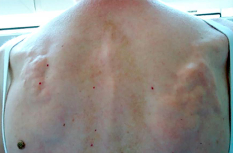 Musculoskeletal involvement in systemic sclerosis.