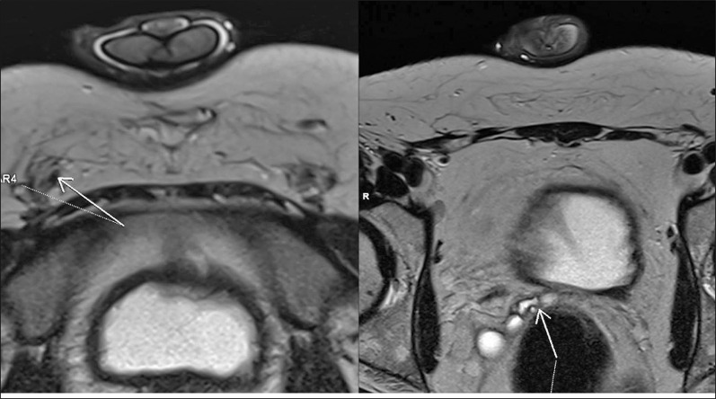 Magnetic resonance vasography using paramagnetic contrast agent - a case report.