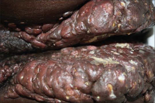 Atypical presentation of molluscum contagiosum infection in a human immunodeficiency virus-positive patient.