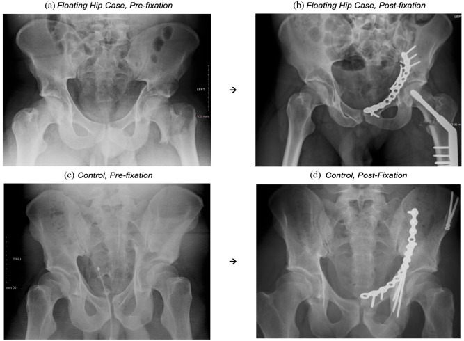 The floating hip injury: a descriptive study and case-control analysis.