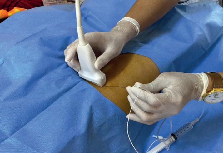 Ultrasound-guided Femoral - Sciatic Nerve Block for Lower Limb Long Bone Fractures.