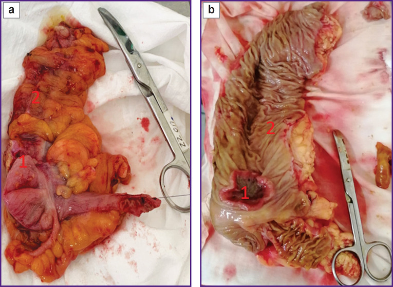 Diagnosis of Colorectal Cancer and Adenomatous Polyps of the Colon Based on the Level of MicroRNA Expression in the Mucous Membrane (Pilot Clinical Study).