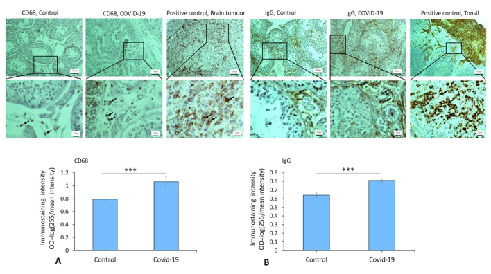 Vimentin as a contributing factor in SARS-CoV-2-induced orchitis on postmortem testicular autopsy of COVID-19 cases: A case-control study.