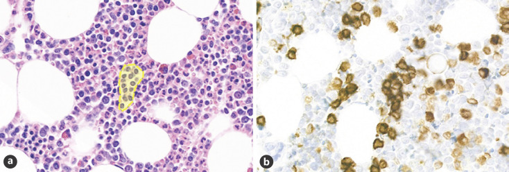Artificial Intelligence in Bone Marrow Histological Diagnostics: Potential Applications and Challenges.