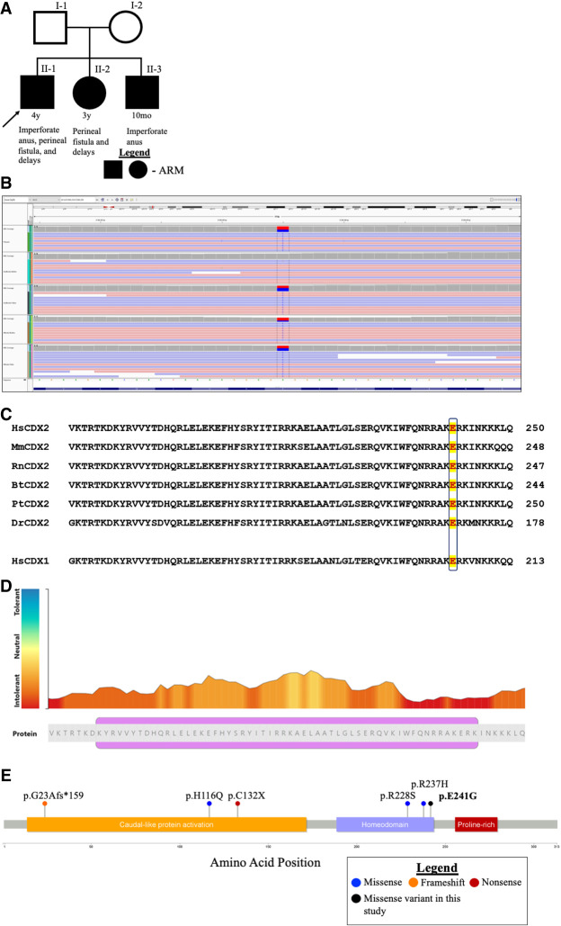 Novel inherited <i>CDX2</i> variant segregating in a family with diverse congenital malformations of the genitourinary system.