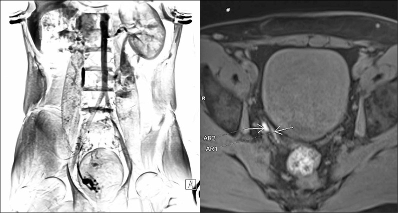 Magnetic resonance vasography using paramagnetic contrast agent - a case report.