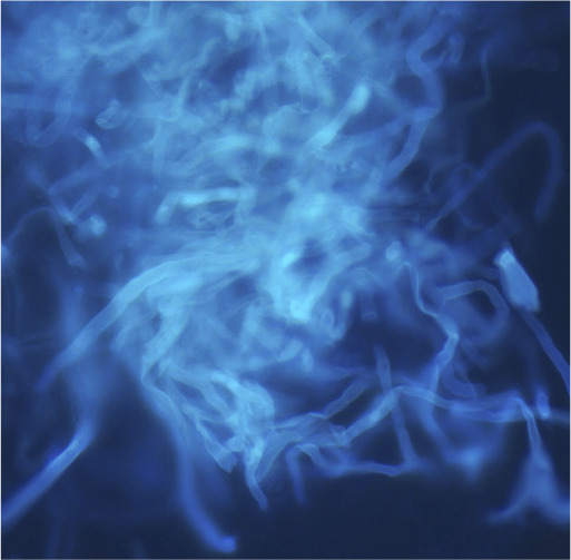 <i>Pythium insidiosum</i>: the organism that mimics fungal keratitis.