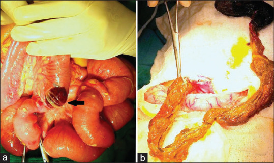 A Convoluted Tale of Rapunzel Tail: With Dislodged Daughter Bezoar as Lead Point for Intussusception.