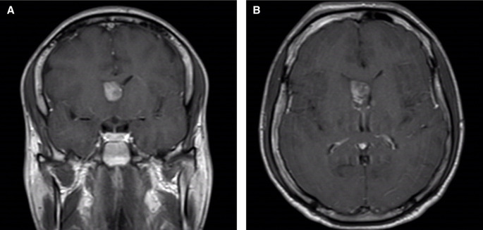 Incidental choroid plexus papilloma in a forensic psychiatric inpatient: a case report.